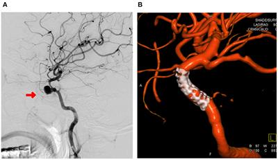 The Clinical Efficacy Analysis of Treatment With a Willis Covered Stent in Traumatic Pseudoaneurysm of the Internal Carotid Artery